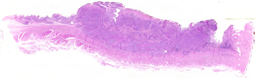 necrotizing enterocolitis histology