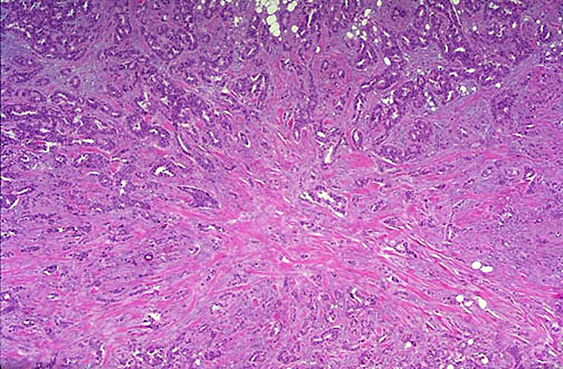 Duke Pathology - Neoplasia