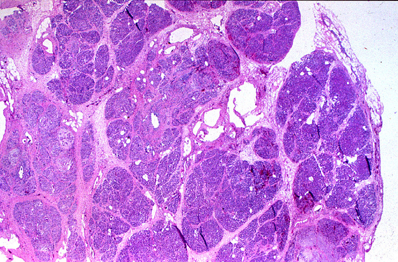 pancreatic pseudocyst histology